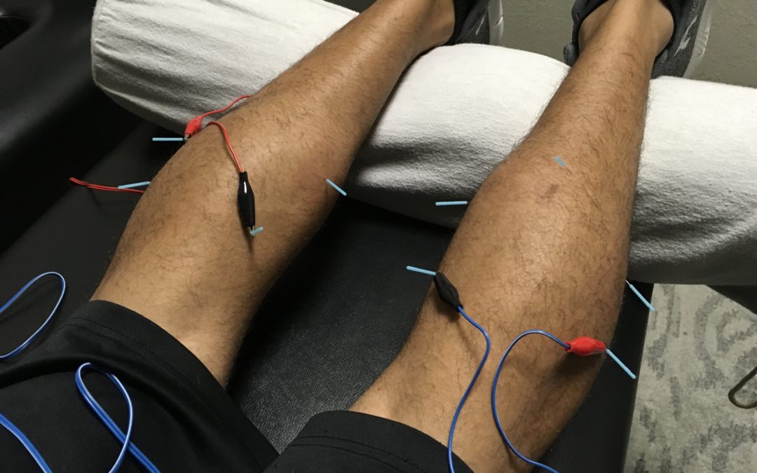 What Is Dry Needling in Physical Therapy?